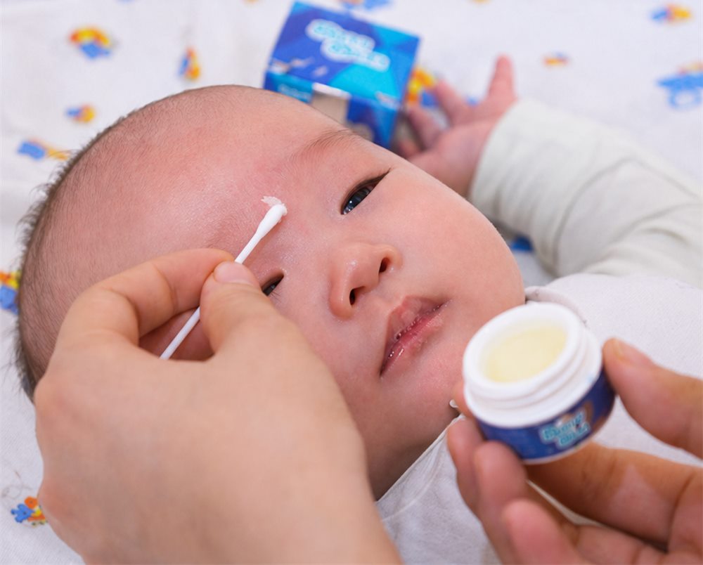 Mẹ dùng tăm bông chấm Kem Bon Bon lên da bé