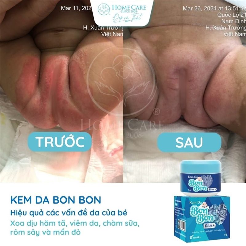 Vùng bẹn bé trước và sau khi dùng kem