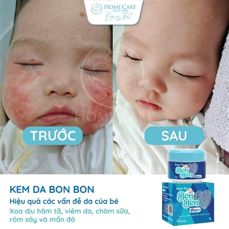 Má bé trước và sau khi dùng kem