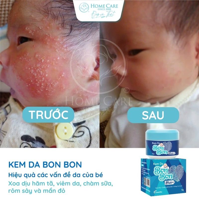 Mặt bé nổi mẩn trước và sau khi dùng kem