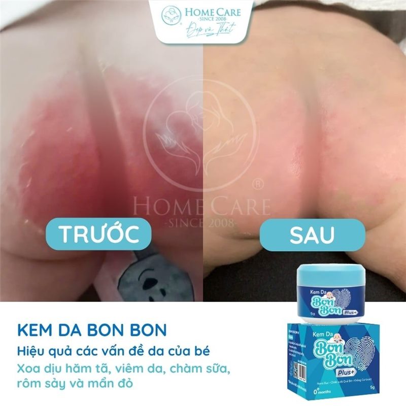 Mông bé trước và sau khi dùng kem